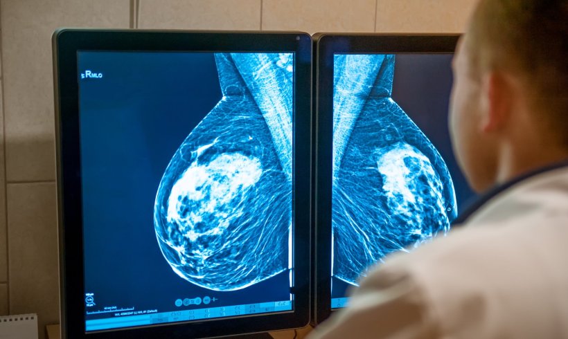 Doctor examines breast mammogram on dual monitors