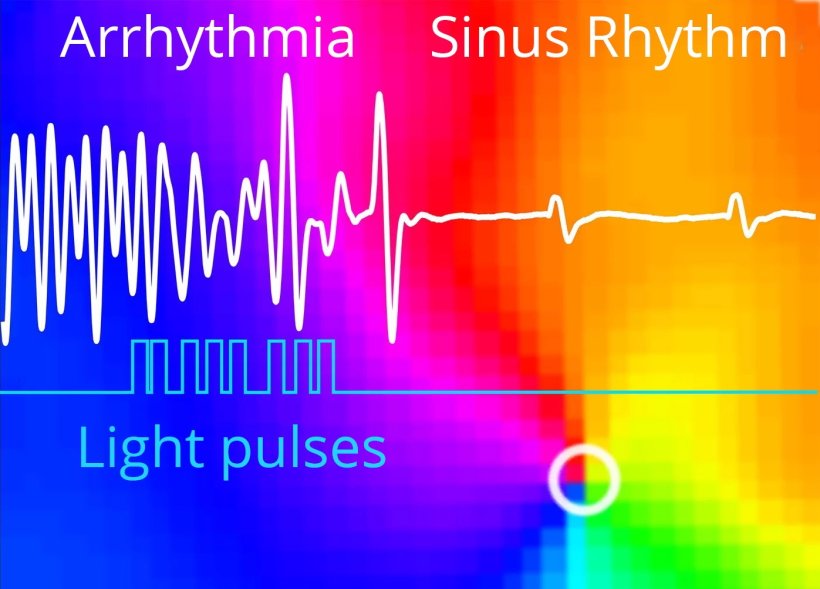 A cardiac ventricular arrhythmia can be converted to a normal sinus rhythm...